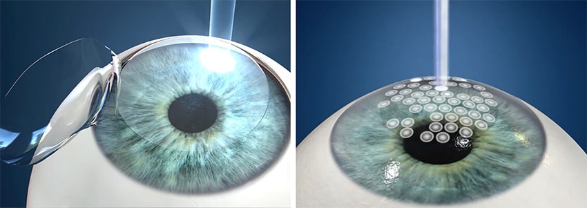 Best Lasik Surgery In Boston Massachusetts