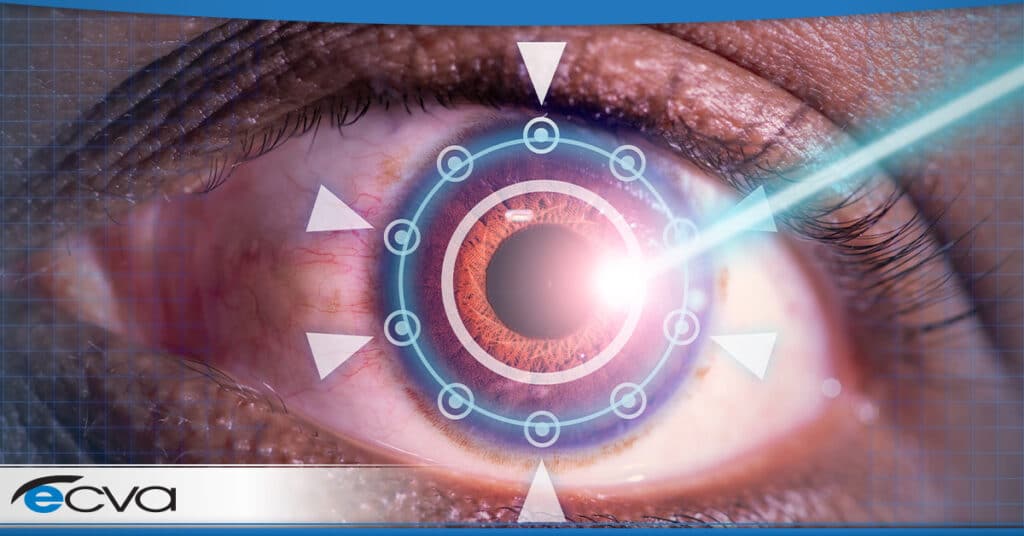 Best Lasik Surgery In Buffalo New York