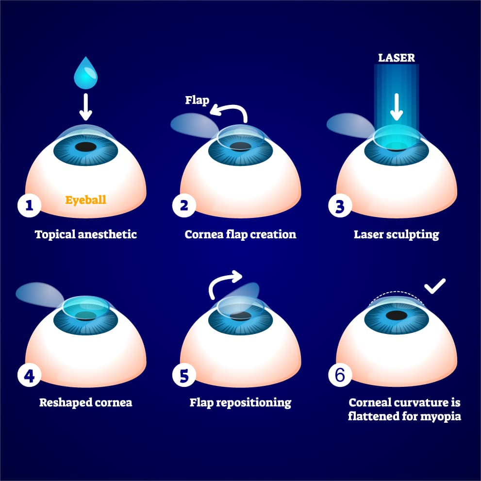 Best Lasik Surgery In Corpus Christi Texas