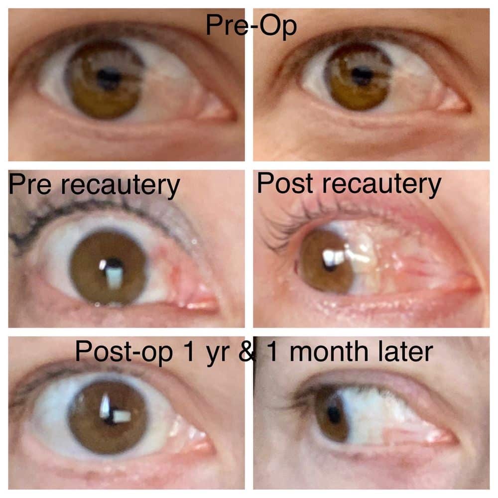 Best Lasik Surgery In Glendale California