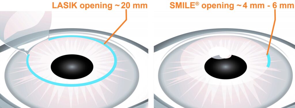 Best Lasik Surgery In Irving Texas