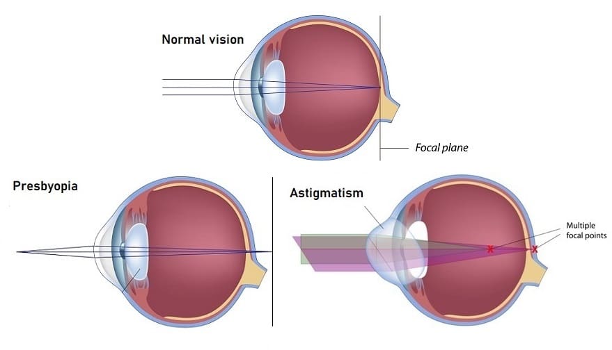 Best Lasik Surgery In Kansas City Missouri