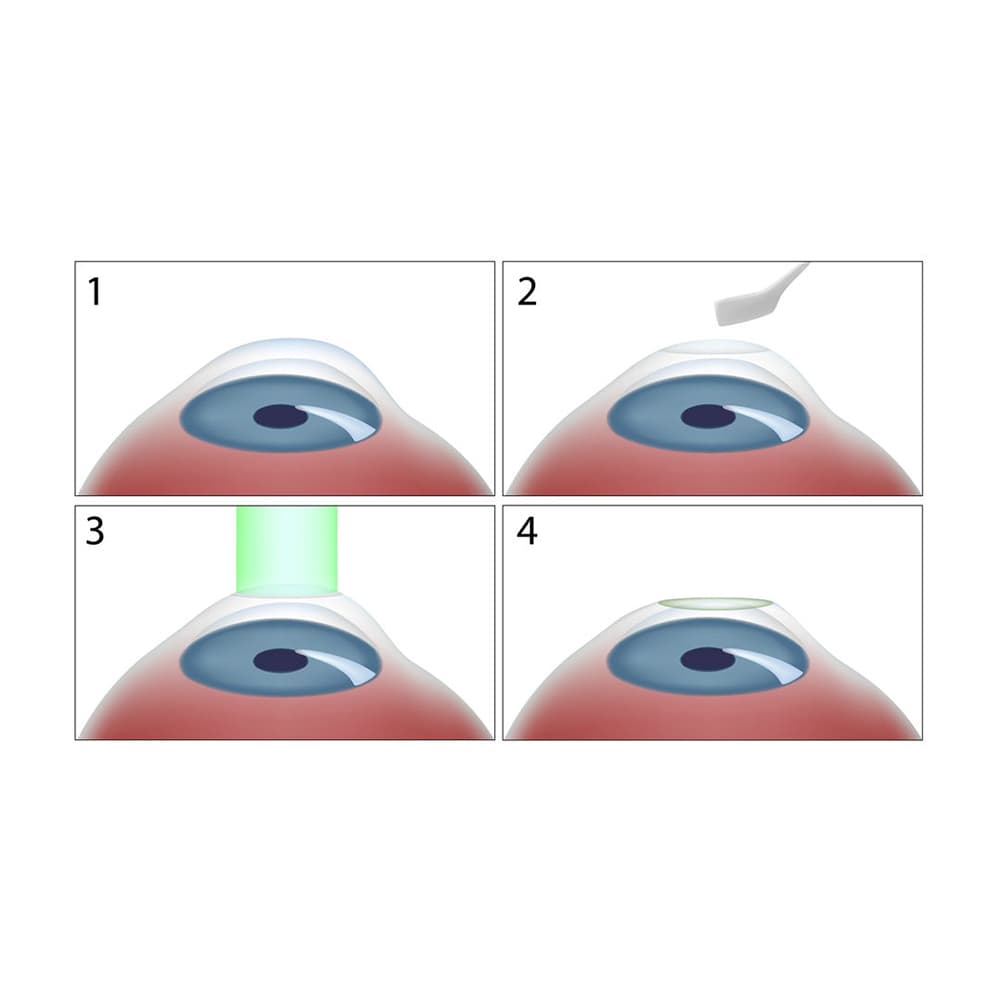 Best Lasik Surgery In Norfolk Virginia