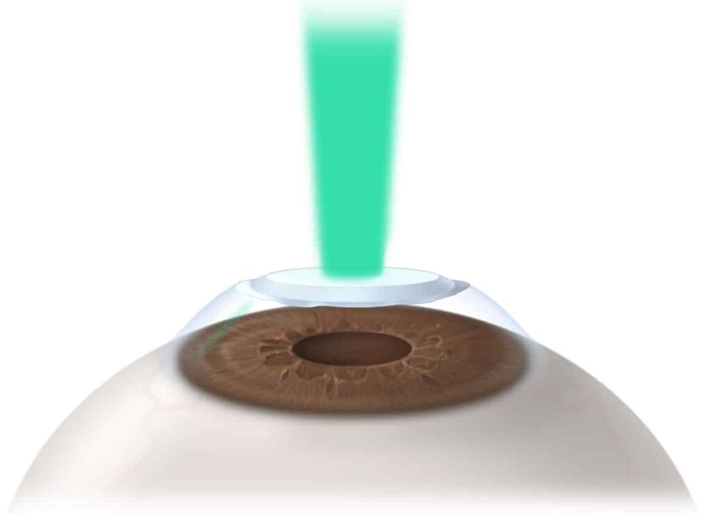 Best Lasik Surgery In Stockton California