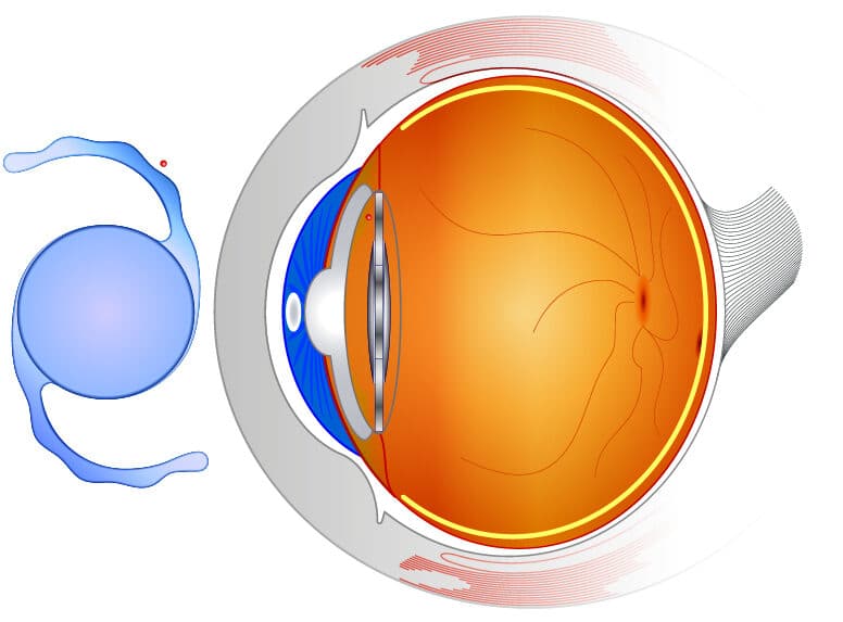 Best Lasik Surgery In Stockton California