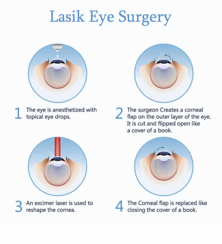 Is LASIK a painful procedure?