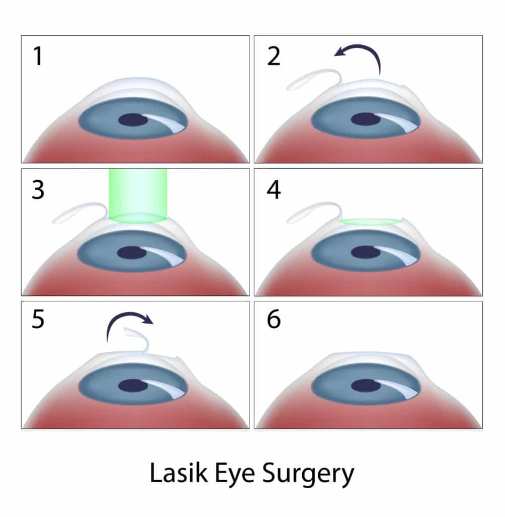 Is LASIK a painful procedure?