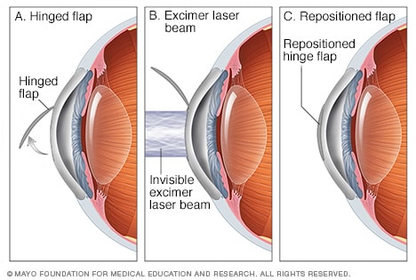 Is Lasik Surgery Safe?