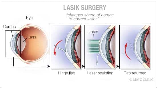 Risks and Considerations of Laser Eye Surgery