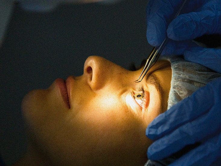 Risks and Considerations of Laser Eye Surgery