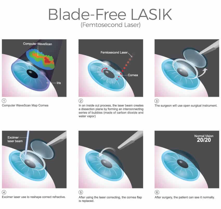 Best Lasik Surgery In Cape Coral Florida Best Lasik Surgery In Cape Coral Florida