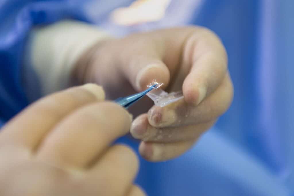 Best Lasik Surgery In Green Bay Wisconsin