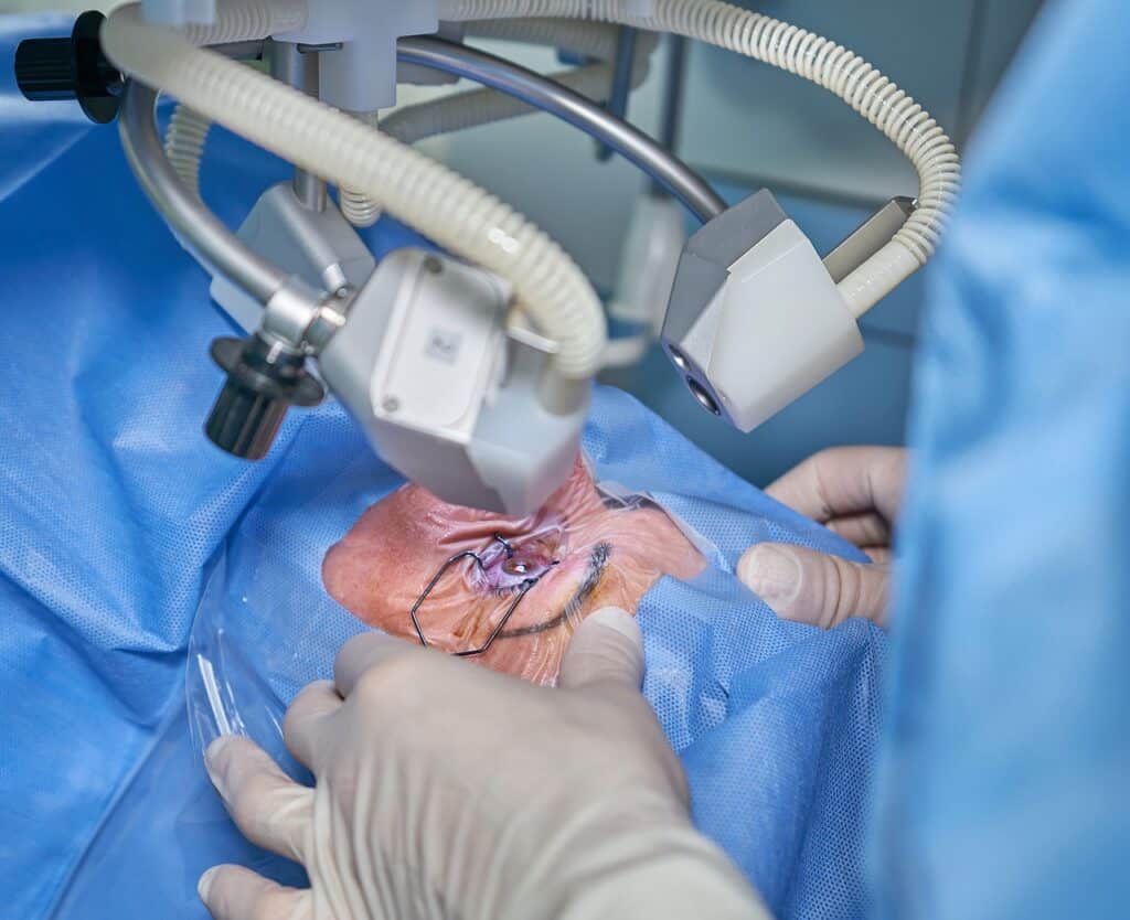 Best Lasik Surgery In San Buenaventura Ventura California