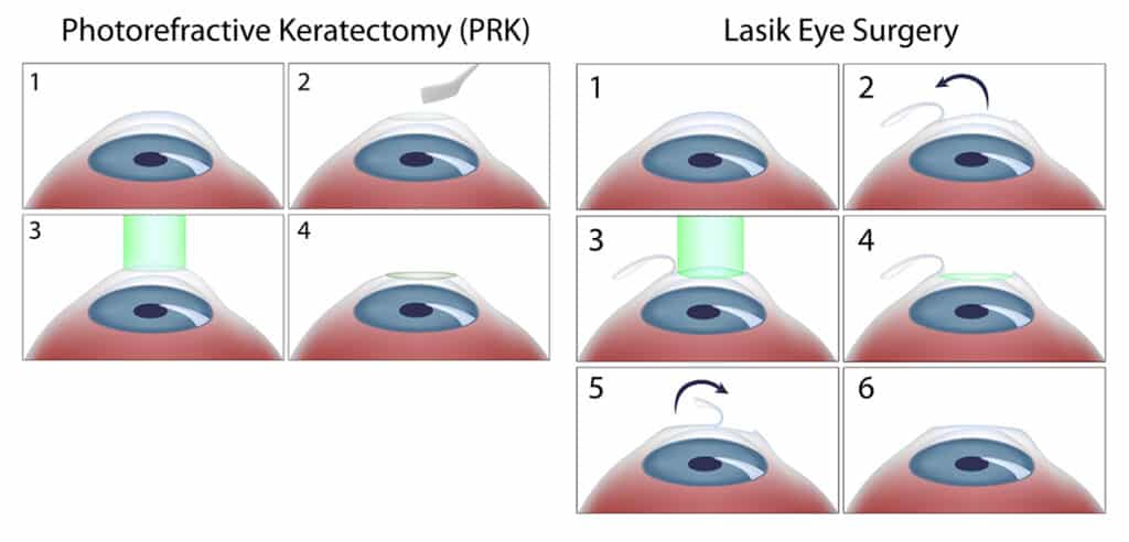 Best Lasik Surgery In Wichita Falls Texas
