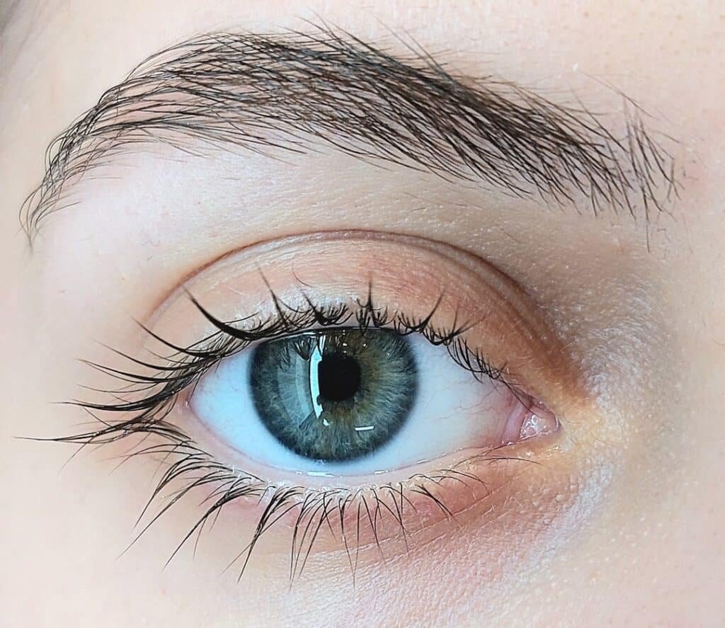 Photo Lasik Eye Surgery